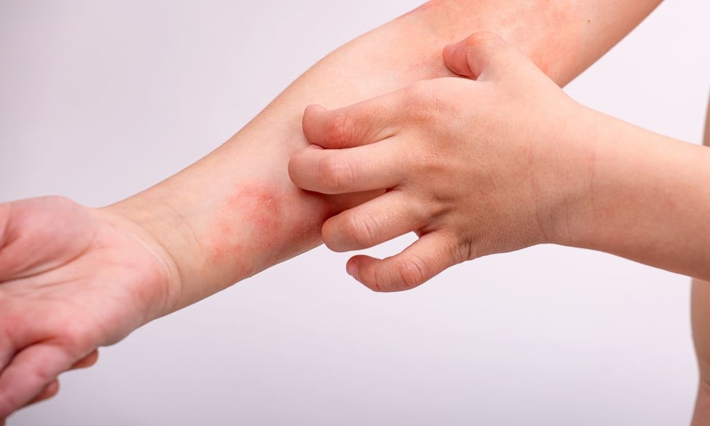 Kontaktní dermatitida