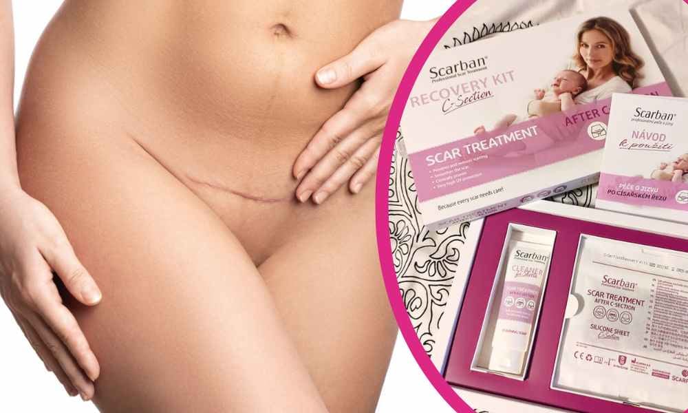 Testování Scarban C-section zkušenosti recenze reference