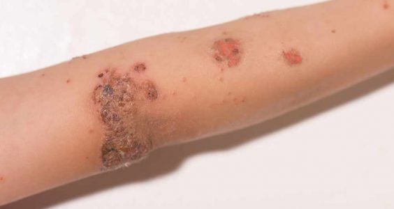 Impetigo léčba prevence