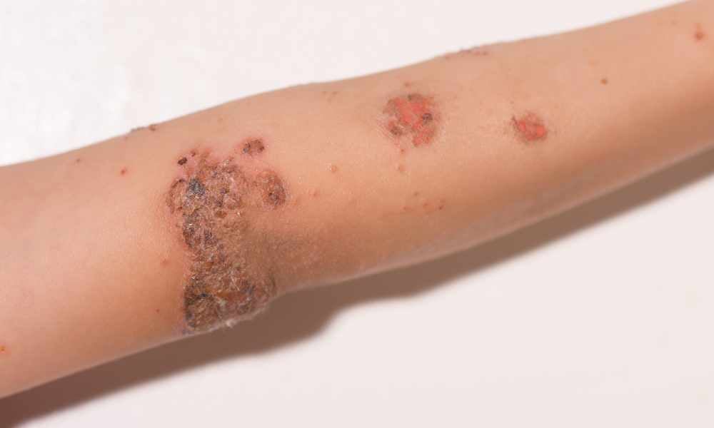 Impetigo léčba prevence