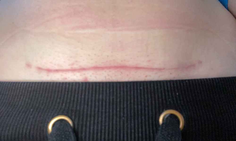 Testování Scarban C-section zkušenosti recenze reference