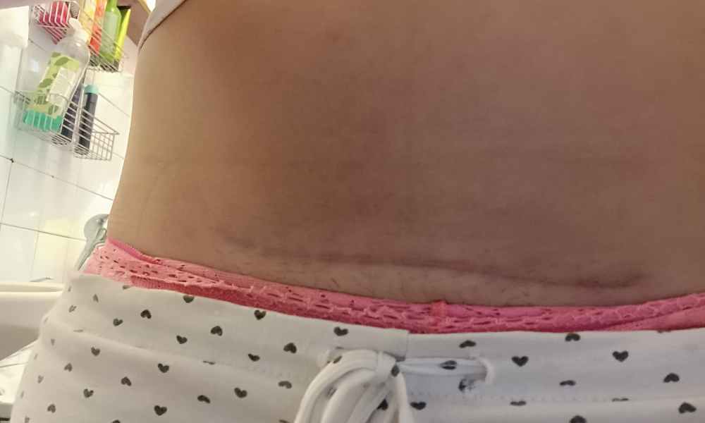 Testování Scarban C-section zkušenosti recenze reference